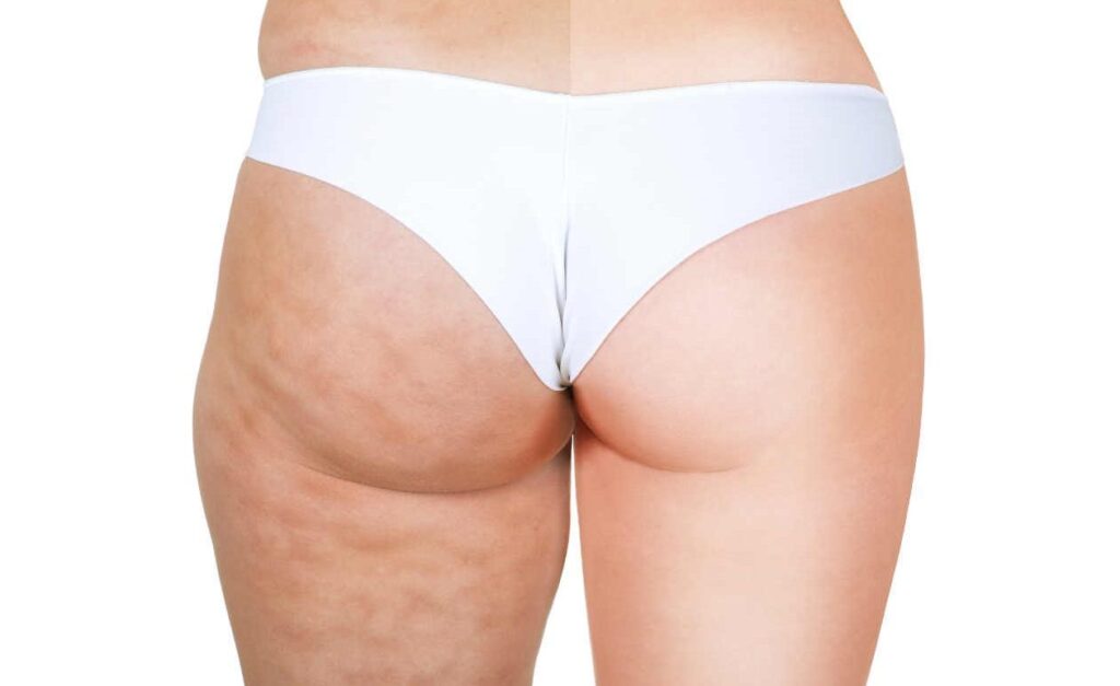 Qué es la Mesoterapia corporal