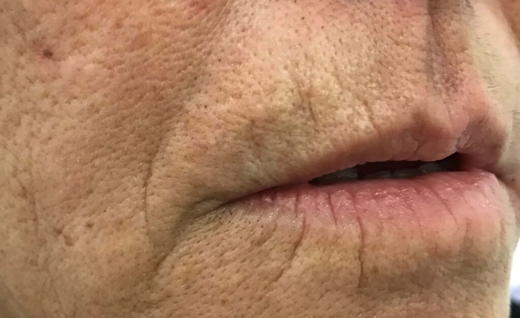 Medicina Estética para Eliminar Arrugas en los Labios.
