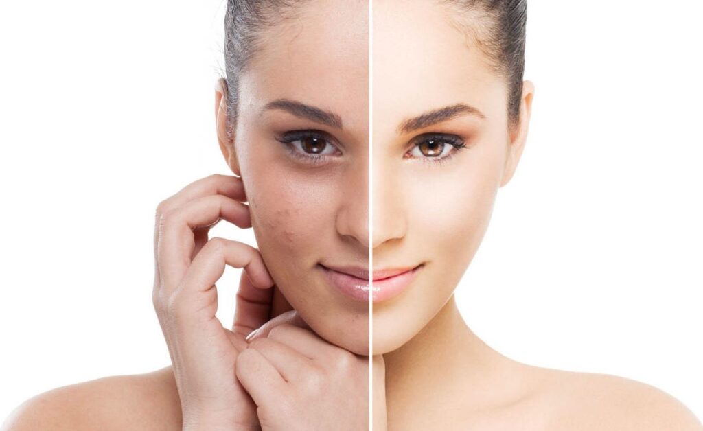 El Peeling Químico sirve para rejuvenecer la piel.