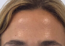 Clinica-Vieira-Tratamientos-para-las-arrugas-de-expresion-patas-de-gallo-