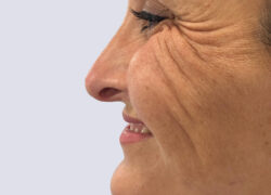 Clinica-Vieira-Tratamientos-para-las-arrugas-de-expresion-patas-de-gallo-1